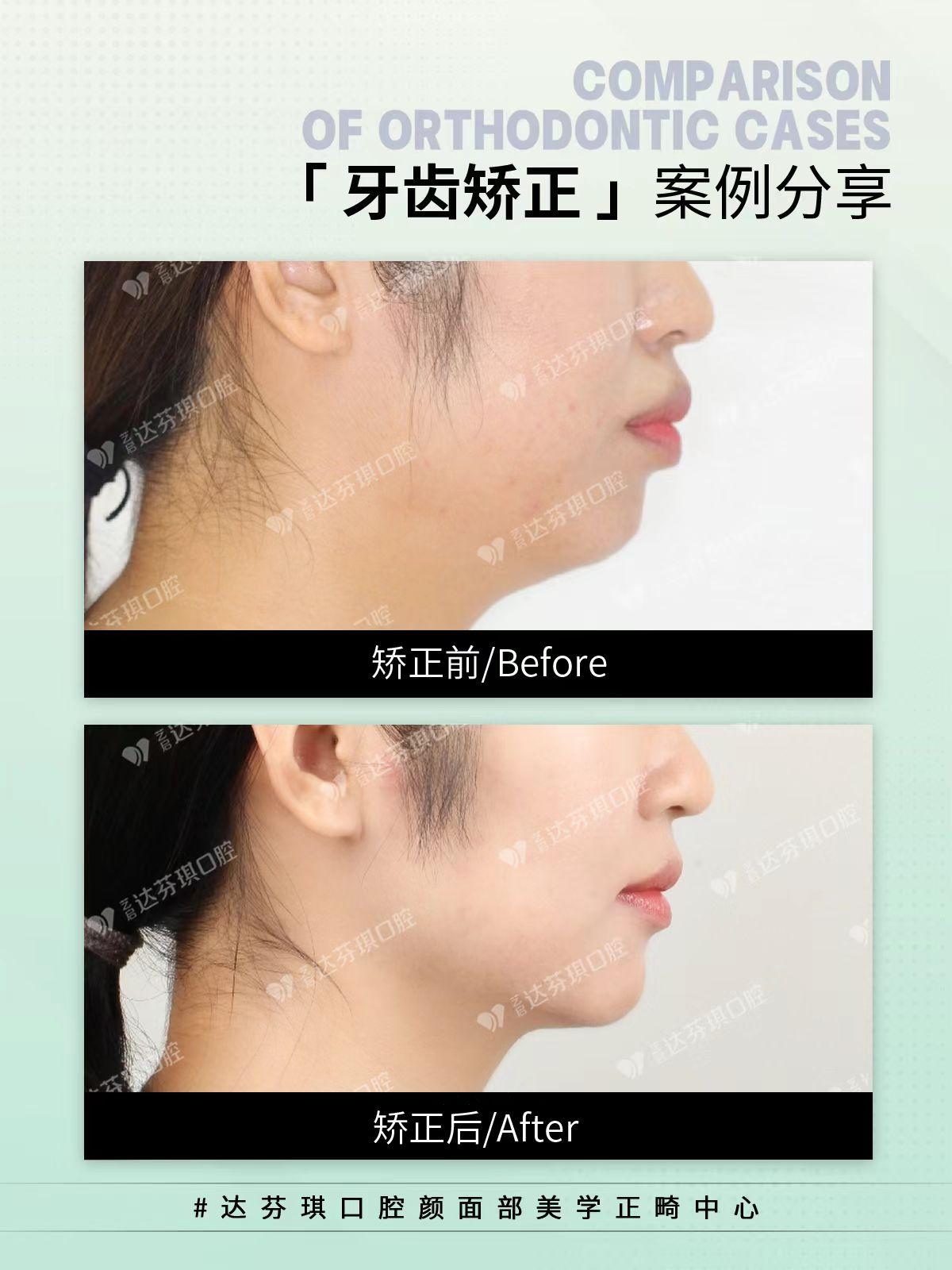 达芬琪口腔外环境