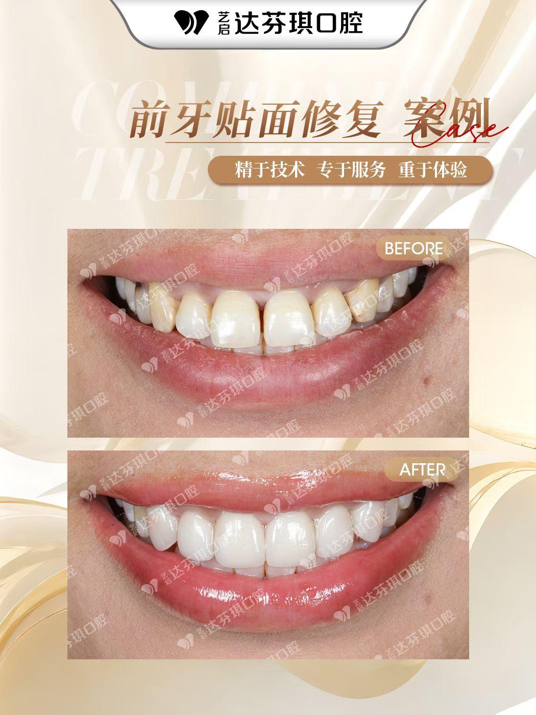 达芬琪口腔内部环境